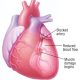 Mastering Myocardial Infarction (Heart Attack) in Preparation for NCLEX Exam