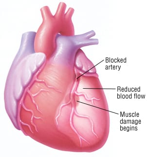 Mastering Myocardial Infarction (Heart Attack) in Preparation for NCLEX Exam