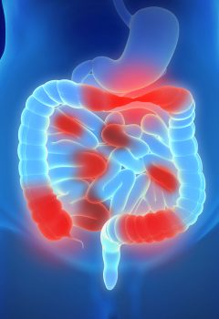 Mastering Inflammatory Bowel Disease (IBD) for the NCLEX Exam 2024: A Focus on Crohn’s Disease and Ulcerative Colitis
