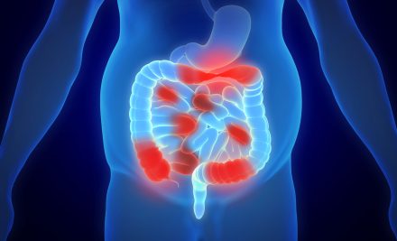 Mastering Inflammatory Bowel Disease (IBD) for the NCLEX Exam 2024: A Focus on Crohn’s Disease and Ulcerative Colitis