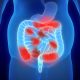 Mastering Inflammatory Bowel Disease (IBD) for the NCLEX Exam 2024: A Focus on Crohn’s Disease and Ulcerative Colitis