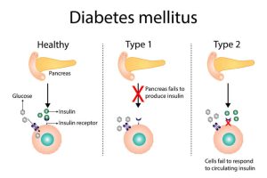 Mastering Diabetes Mellitus (Type 1 and Type 2) for the NCLEX Exam