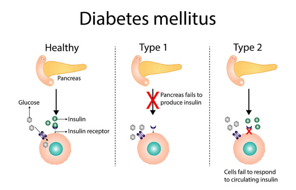 Mastering Diabetes Mellitus (Type 1 and Type 2) for the NCLEX Exam