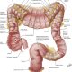 Comprehensive Care for a Client with Lower Gastrointestinal Tract Health Problems: An NCLEX-Standard Guide