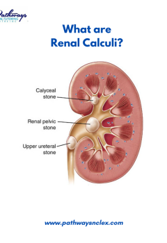 Renal Calculi (Kidney Stones): Essential Guide for NCLEX Exam