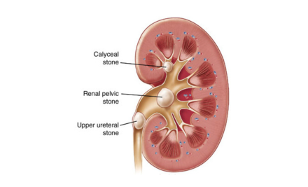 Renal Calculi (Kidney Stones): Essential Guide for NCLEX Exam