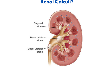 Renal Calculi (Kidney Stones): Essential Guide for NCLEX Exam