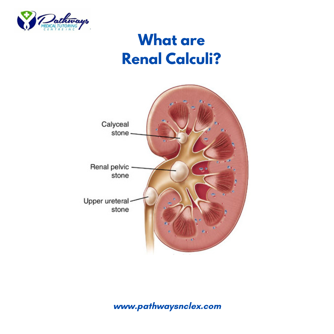 Renal Calculi (Kidney Stones): Essential Guide for NCLEX Exam