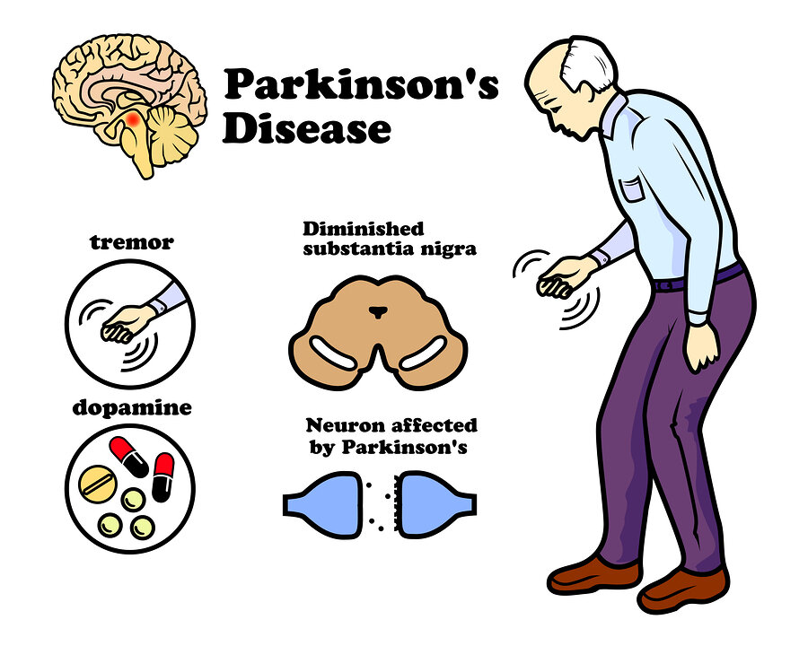 Parkinson’s Disease: Causes, Symptoms, and Care – NCLEX Guide