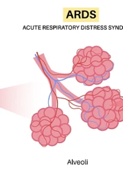 Acute Respiratory Distress Syndrome (ARDS): A Guide for NCLEX Exam Preparation