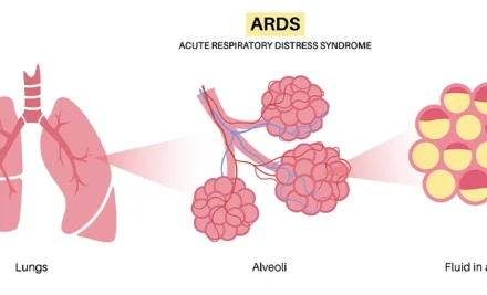 Acute Respiratory Distress Syndrome (ARDS): A Guide for NCLEX Exam Preparation