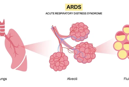 Acute Respiratory Distress Syndrome (ARDS): A Guide for NCLEX Exam Preparation