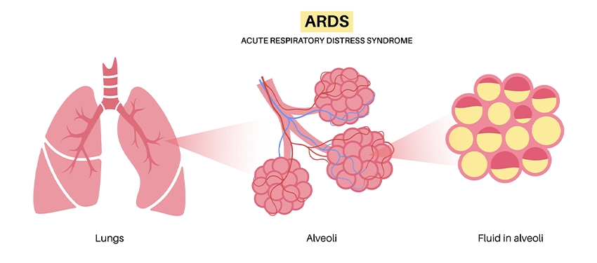 Acute Respiratory Distress Syndrome (ARDS): A Guide for NCLEX Exam ...