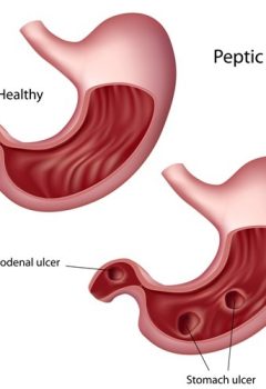 Mastering Peptic Ulcer Disease (PUD) for the NCLEX Exam