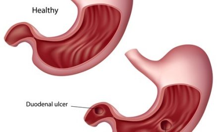 Mastering Peptic Ulcer Disease (PUD) for the NCLEX Exam