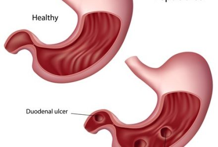 Mastering Peptic Ulcer Disease (PUD) for the NCLEX Exam