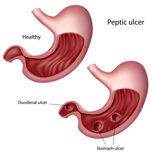 Mastering Peptic Ulcer Disease (PUD) for the NCLEX Exam