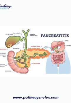 Pancreatitis: A Comprehensive Guide for NCLEX Exam Preparation