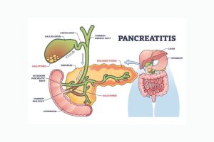 Pancreatitis: A Comprehensive Guide for NCLEX Exam Preparation