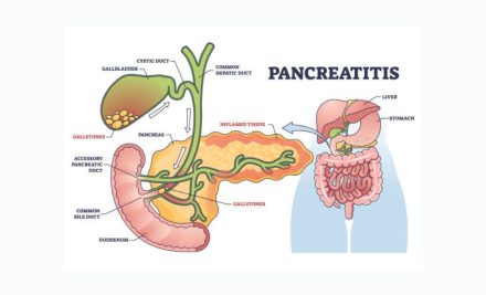 Pancreatitis: A Comprehensive Guide for NCLEX Exam Preparation