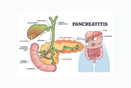 Pancreatitis: A Comprehensive Guide for NCLEX Exam Preparation