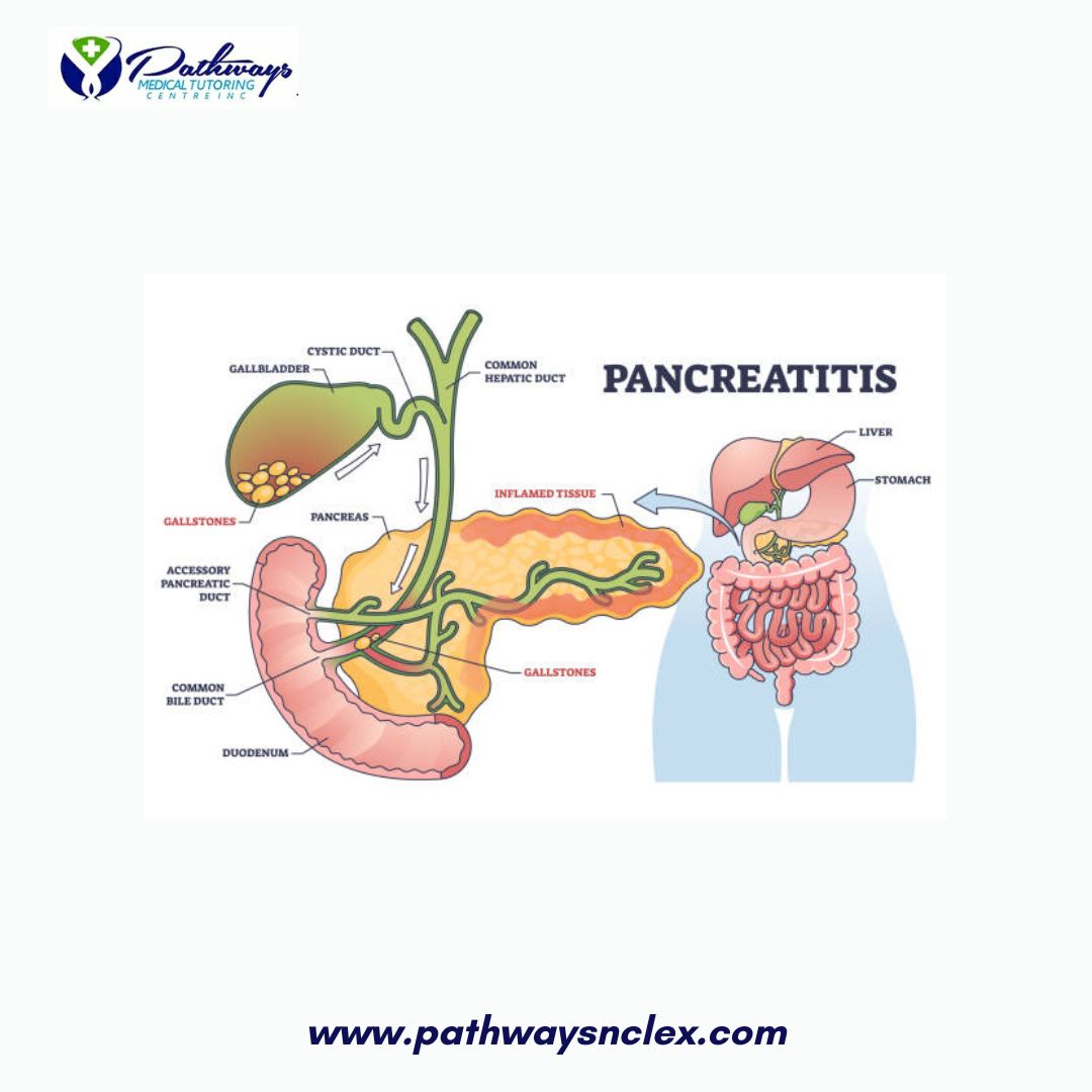 Pancreatitis: A Comprehensive Guide for NCLEX Exam Preparation