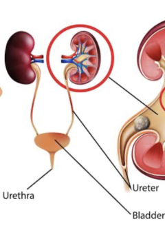 RENAL AND URINARY DISORDERS: MANAGING UTIs, KIDNEY STONES, AND DIALYSIS CARE. 