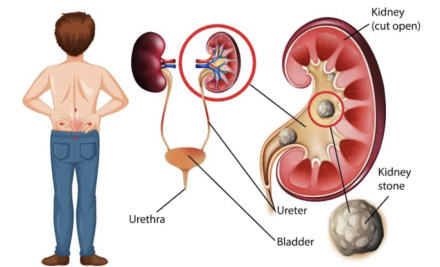 RENAL AND URINARY DISORDERS: MANAGING UTIs, KIDNEY STONES, AND DIALYSIS CARE. 