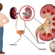 RENAL AND URINARY DISORDERS: MANAGING UTIs, KIDNEY STONES, AND DIALYSIS CARE. 