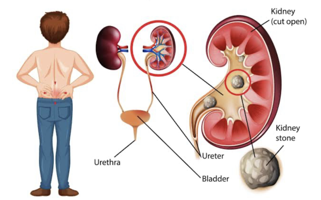 RENAL AND URINARY DISORDERS: MANAGING UTIs, KIDNEY STONES, AND DIALYSIS CARE. 