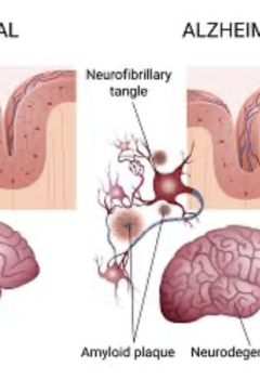 COGNITIVE DISORDERS: ALZHEIMER’S DISEASE AND DEMENTIA ON THE NCLEX