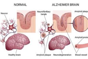 COGNITIVE DISORDERS: ALZHEIMER’S DISEASE AND DEMENTIA ON THE NCLEX