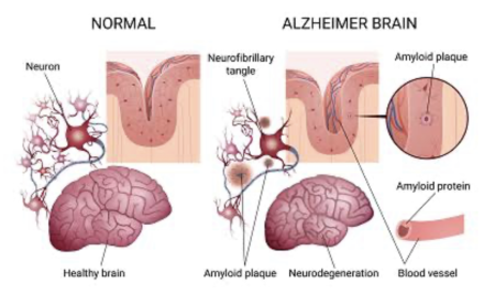 COGNITIVE DISORDERS: ALZHEIMER’S DISEASE AND DEMENTIA ON THE NCLEX