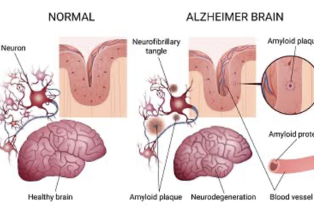 COGNITIVE DISORDERS: ALZHEIMER’S DISEASE AND DEMENTIA ON THE NCLEX