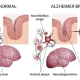 COGNITIVE DISORDERS: ALZHEIMER’S DISEASE AND DEMENTIA ON THE NCLEX