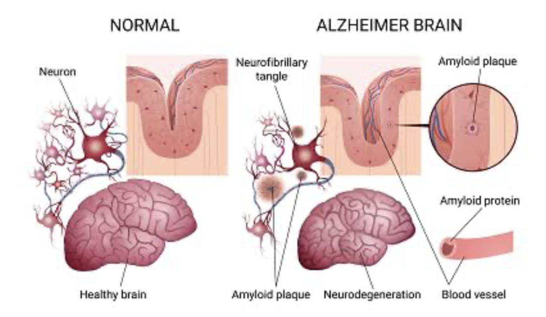 COGNITIVE DISORDERS: ALZHEIMER’S DISEASE AND DEMENTIA ON THE NCLEX