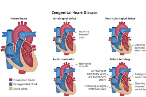 CONGENITAL HEART DEFECTS IN CHILDREN: NCLEX-STYLE QUESTIONS AND KEY NURSING INTERVENTIONS