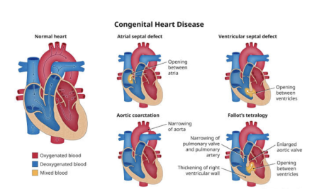 CONGENITAL HEART DEFECTS IN CHILDREN: NCLEX-STYLE QUESTIONS AND KEY NURSING INTERVENTIONS