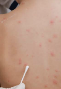 SKIN DISORDERS IN CHILDREN: DIAPER RASH, ECZEMA, AND MORE FOR NCLEX