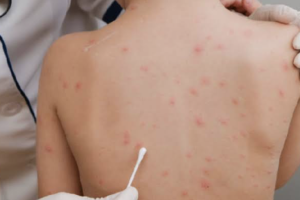 SKIN DISORDERS IN CHILDREN: DIAPER RASH, ECZEMA, AND MORE FOR NCLEX