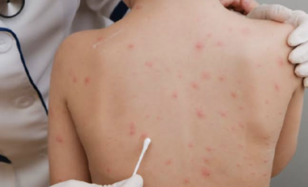 SKIN DISORDERS IN CHILDREN: DIAPER RASH, ECZEMA, AND MORE FOR NCLEX