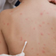 SKIN DISORDERS IN CHILDREN: DIAPER RASH, ECZEMA, AND MORE FOR NCLEX