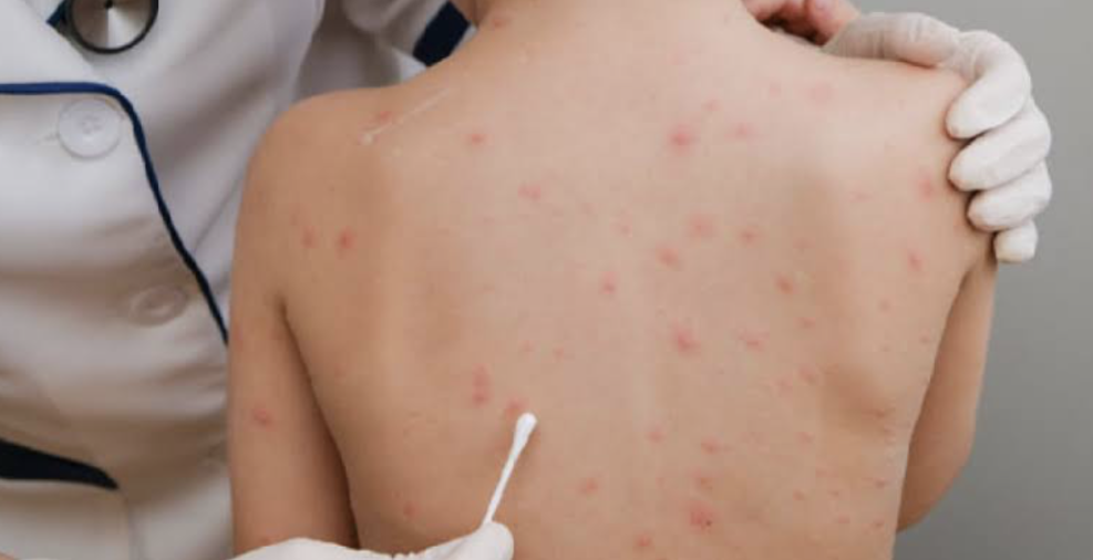 SKIN DISORDERS IN CHILDREN: DIAPER RASH, ECZEMA, AND MORE FOR NCLEX